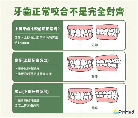 上排牙齒突出面相